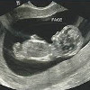 УЗИ-скрининг 2 триместра беременности