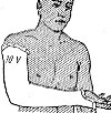 Наложение гипсовой повязки до верхней трети плеча