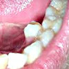 Удаление дистопированного зуба