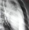 Рентген сердца с контрастированием пищевода
