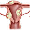 Операции по удалению миомы матки в краснодаре thumbnail