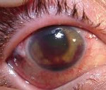 Туберкулёз глаз