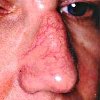 Удаление капиллярной сети в области спинки носа