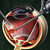 Операция на сетчатке глаза краснодар