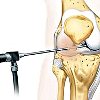 Микроартроскопия коленного сустава с биопсией