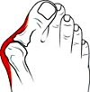 Операция при Hallux valgus