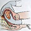 Ручное отделение плаценты и выделение последа