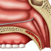 Катетеризация слуховой трубы