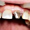 Восстановление культи зуба под коронку